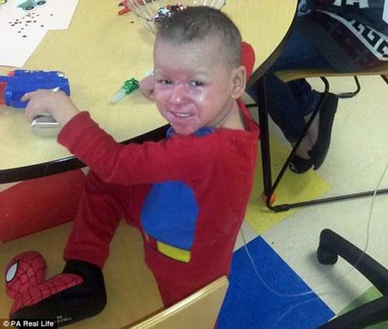美国4岁男童患上罕见皮肤病周身皮肤发红像烫伤