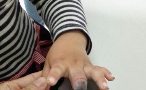 创可贴使用不当致手指坏死-4岁女童竟然要截肢2