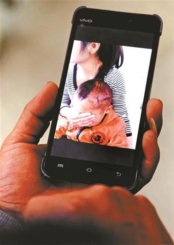男童父亲展示孩子受伤后的照片供图 新华