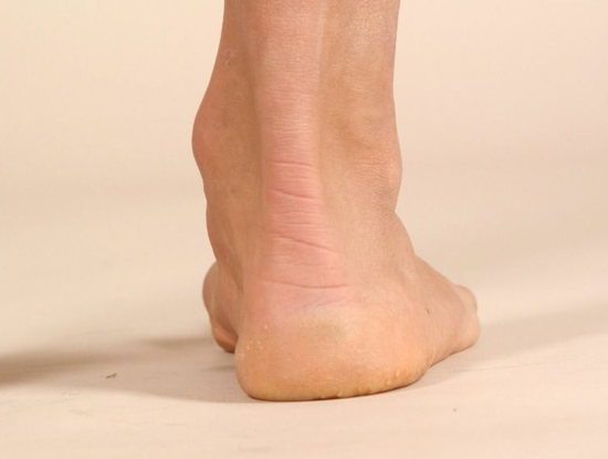 露脚踝小心关节炎 踝关节扭伤的防治要点