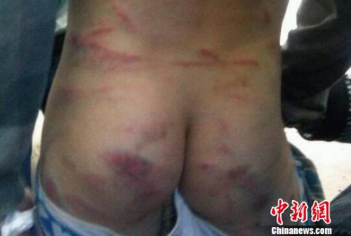 资料图：2014年5月，广东河源一10岁男童在家中惨遭继母暴打，图为被打男童遍体鳞伤。 河源警方供图 