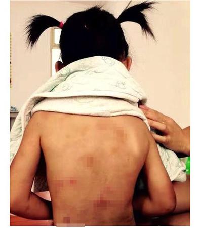 江苏一4岁女孩遭恶性虐待浑身是伤 警方调查