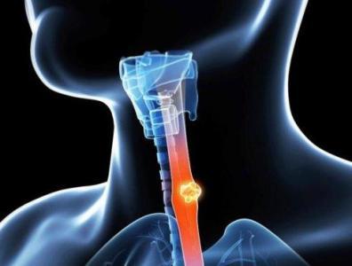 吞咽受阻有可能是患了食道癌？