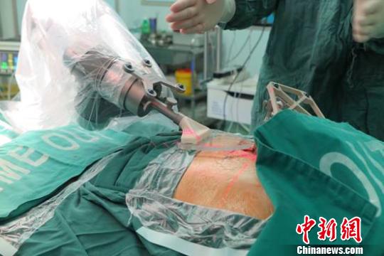 中国东北首例“天玑”机器人辅助脊柱手术在沈阳完成