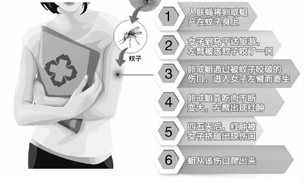 杭州女子到东非旅游感染人肤蝇 手臂竟爬出虫子4