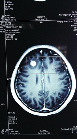 CT扫描显示，小静脑中高亮处疑是寄生虫。