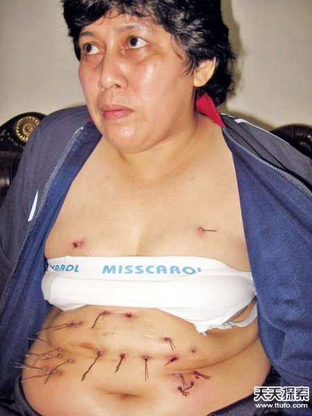 印尼女子患怪病皮肤不断长出金属丝