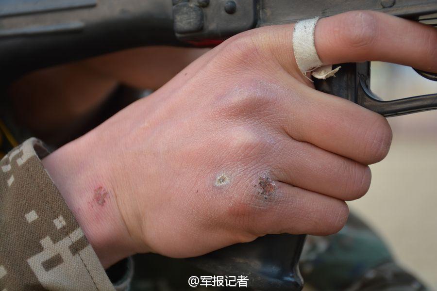 军人手受伤真实照片图片