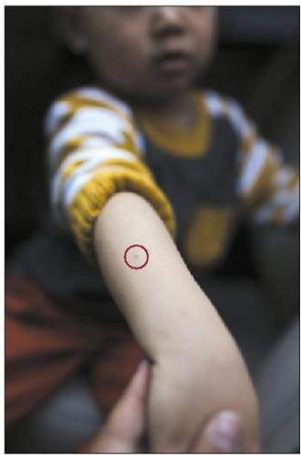 昨日，古城民族幼儿园小班的一名孩童展示被扎后留下的针眼(图中红圈处)。