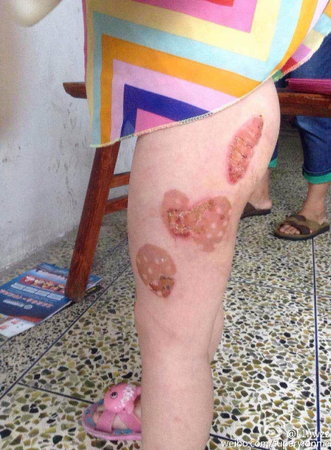 温州4岁女童遭禽兽父亲虐待 双腿多处被灼烫流脓