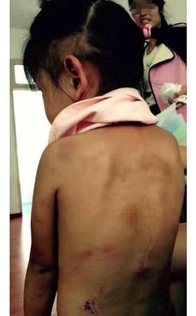 江苏一4岁女孩遭恶性虐待浑身是伤 警方调查