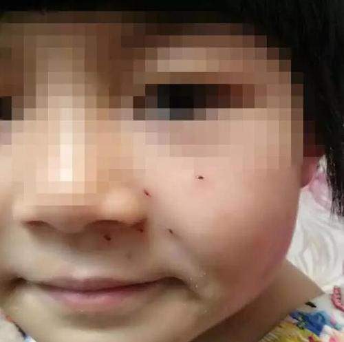 10+9没算好 郑州6岁女童小脸被“老师”扎6个洞