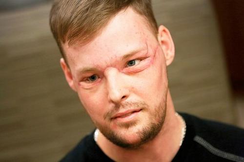 美国男子吞枪脸全毁10年后“换脸”获新生（图）