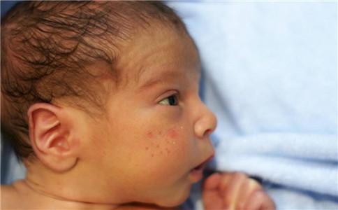 宝宝有湿疹怎么办 治疗湿疹的偏方有哪些 宝宝湿疹如何护理