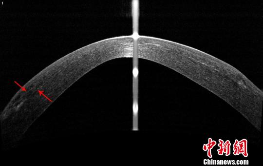 中国眼科专家创新再利用“废”透镜造福角膜病患者