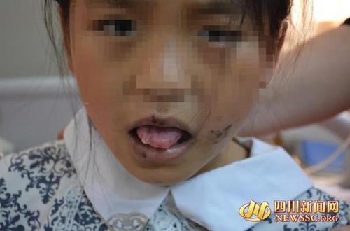 十岁女童遭养母虐待 用钳子夹舌头1